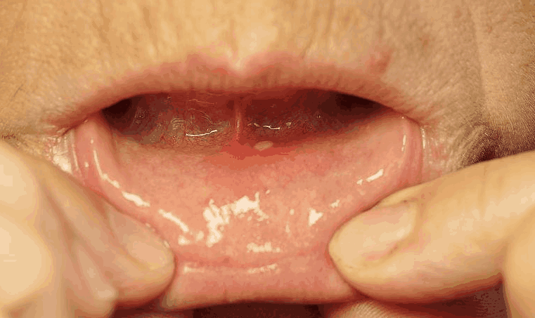 口腔溃疡老复发? 4个“妙招”请收好, 不用麻烦医生